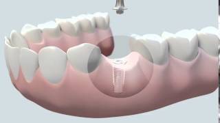 Cómo se coloca un implante dental [upl. by Ybbob]