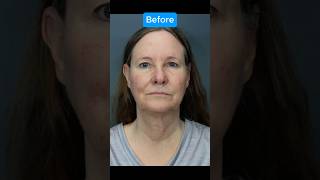 INSANE FACELIFT TRANSFORMATION Journey [upl. by Nika140]