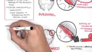 Intracranial Haemorrhage Types signs and symptoms [upl. by Nohsyt]