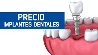 Implantes dentales precio Odontoespecialistas [upl. by Ethyl376]