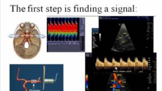 An Introduction to Transcranial Doppler [upl. by Eisso]