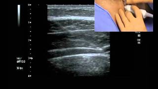 Transverse Abdominis Plane Block ultrasound guided [upl. by Perrine930]