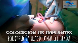 Colocación de implantes dentales [upl. by Jeuz]