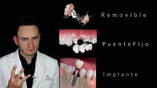 Puentes vs Implantes  ¿Cuál es la mejor opción  Dentista en Querétaro [upl. by Edouard]